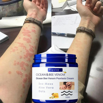 Bee Venom &Ocean Psoriasis Healing Cream ( Pack Of 1 ) - Moda & Main