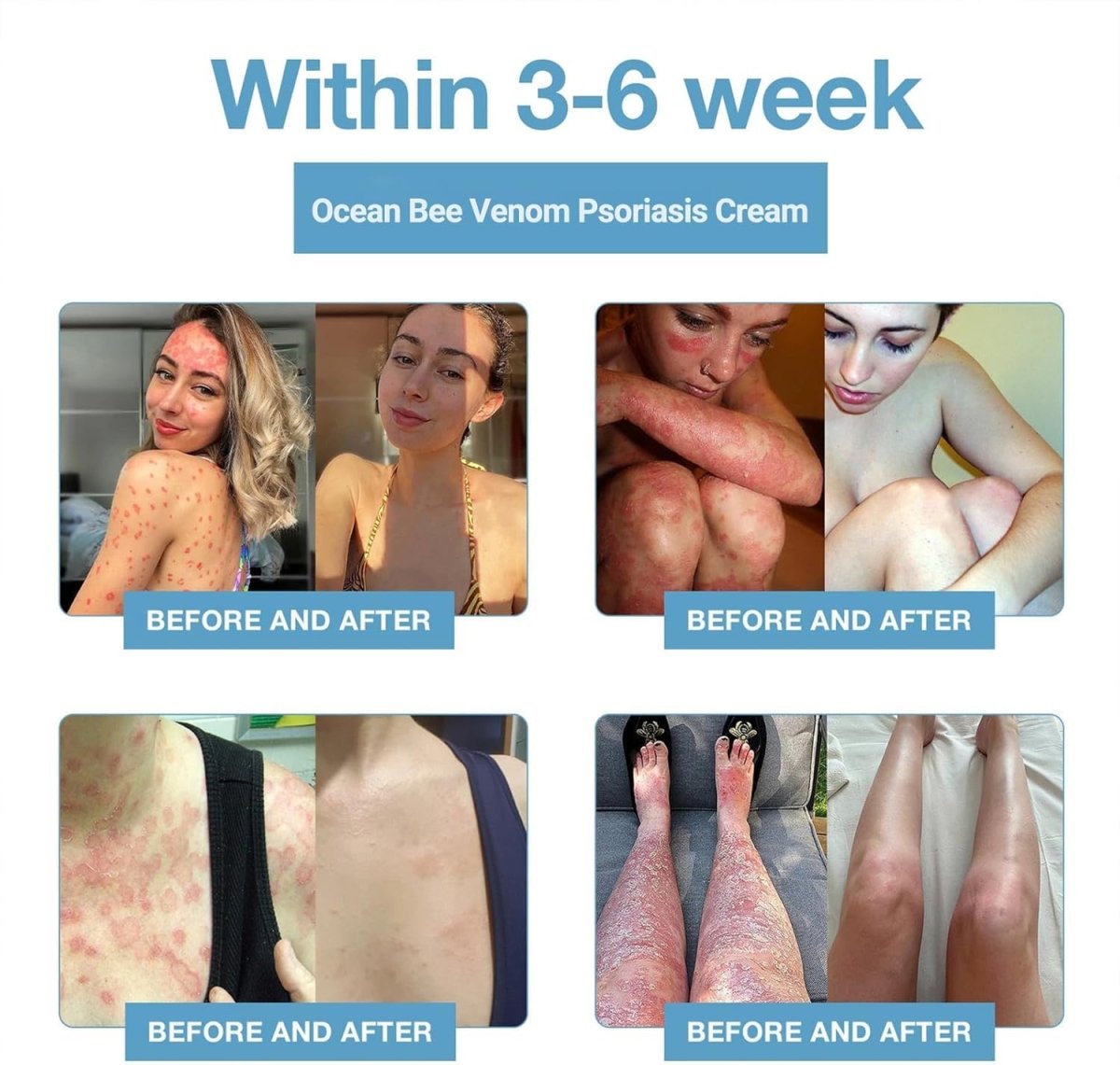 Bee Venom &Ocean Psoriasis Healing Cream ( Pack Of 1 ) - Moda & Main